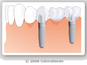 ブリッジタイプ