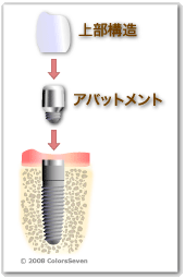 インプラントの構造