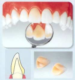 オールセラミック