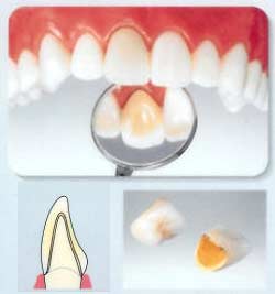 電鋳メタルボンド