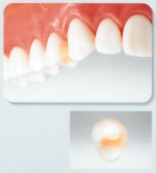 オールセラミック