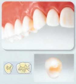 オールセラミック