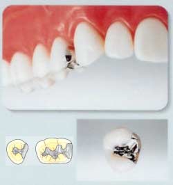 オールセラミック